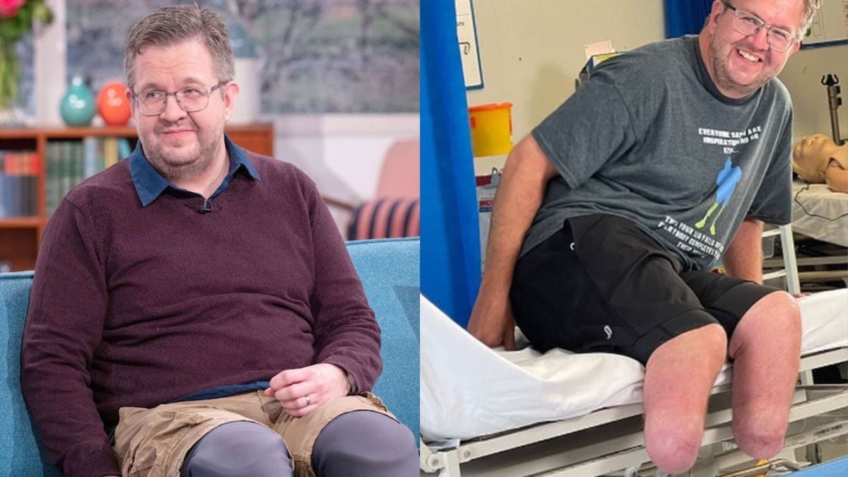 Un chirurgien se coupe lui-même les deux jambes pour frauder les assurances