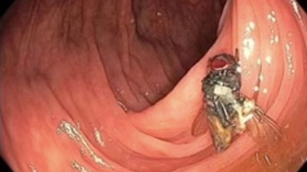 « Un mystère » : des médecins estomaqués en découvrant une mouche vivante dans... le colon d'un patient