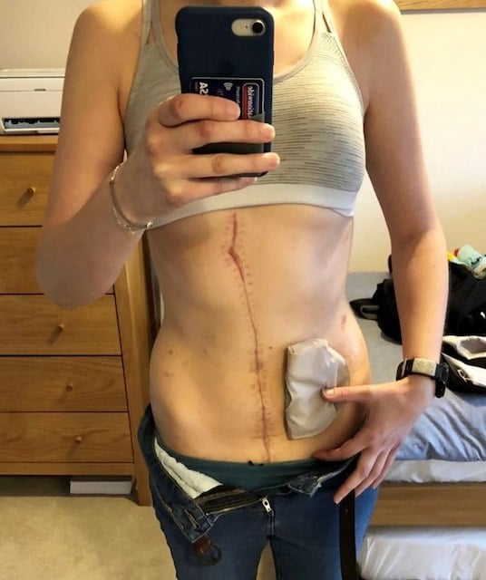 Rebecca Hind après son ablation des organes 