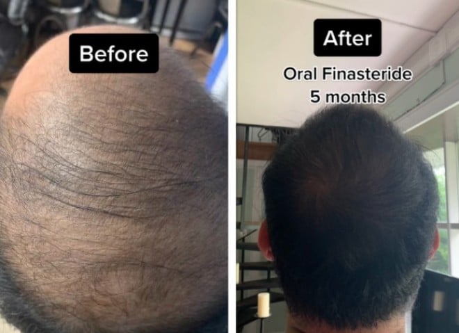Les cheveux avant/après
