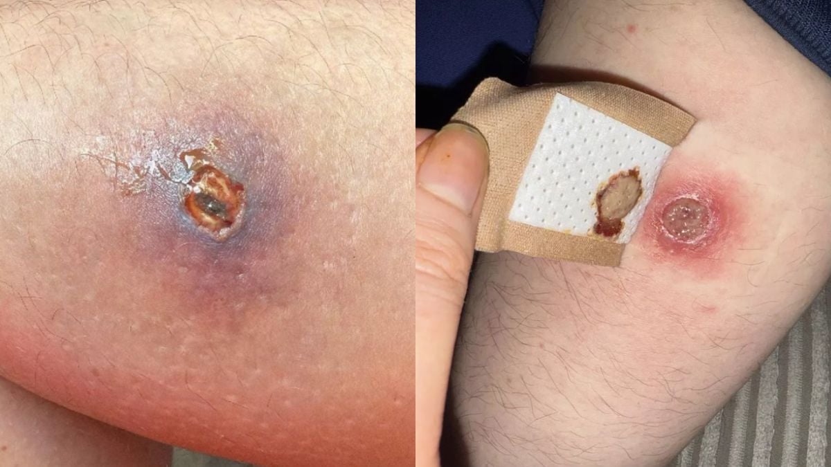 Blessure provoquée par une morsure d'araignée 