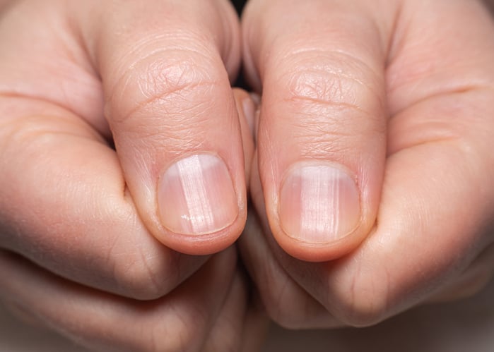 Des ongles striés avec une marque blanche