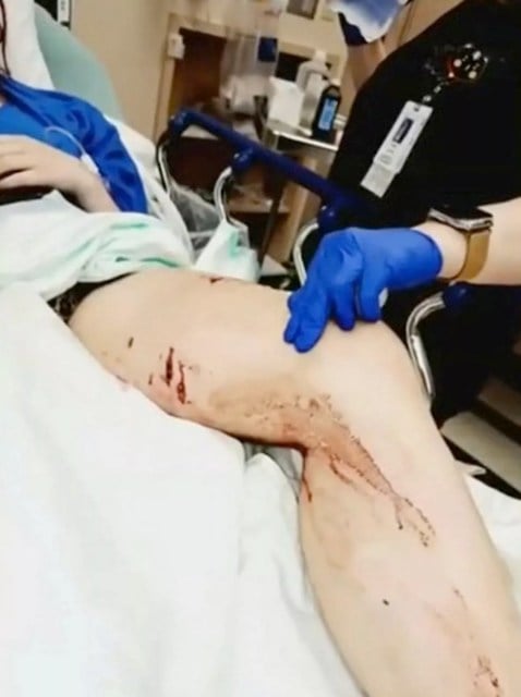 La jambe de Summer Hinote après l'attaque