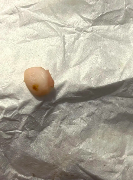 Un morceau de doigt retrouvé dans un wrap au poulet