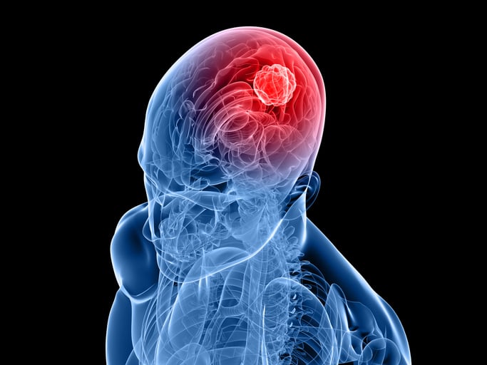 Un cancer du cerveau