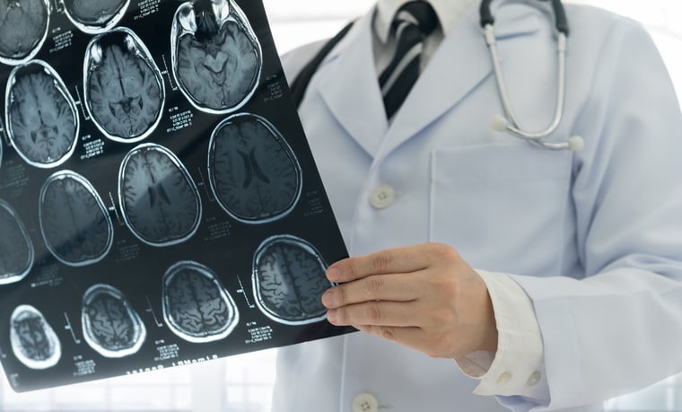 Des radios du cerveau