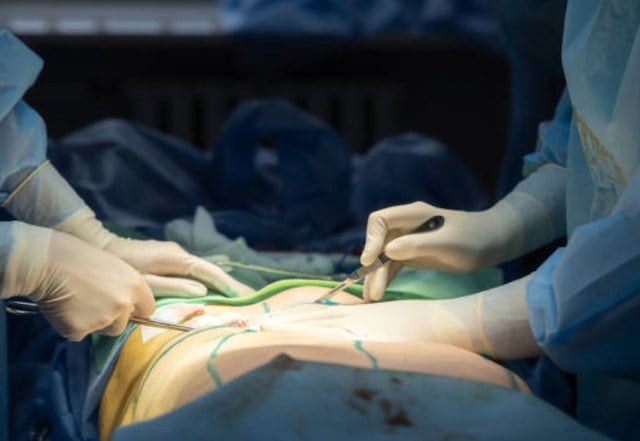 Une abdominoplastie