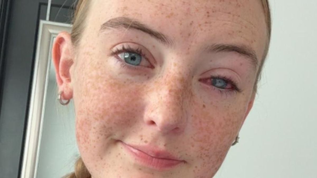 Grace Jamison, jeune femme de 19 ans qui a perdu la vue &agrave; cause d'une... simple douche