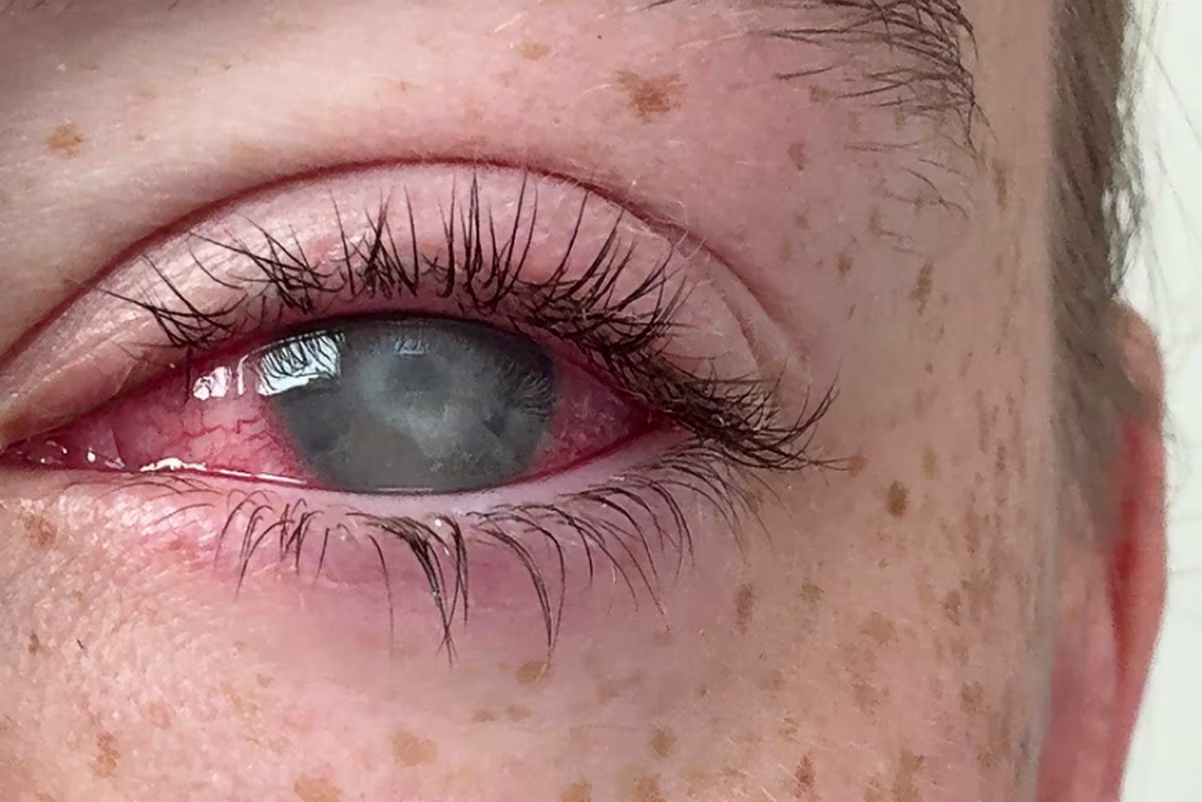 Photo de l'oeil gauche de Grace Jamison, une jeune femme de 19 ans qui a perdu la vue &agrave; cause d'une... simple douche