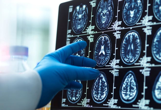 Une radio du cerveau
