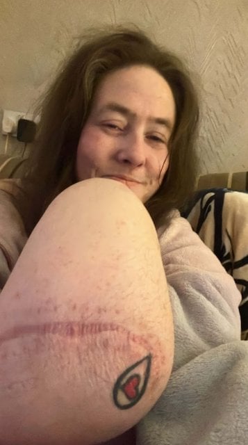 Jayne Stephen apr&egrave;s son amputation