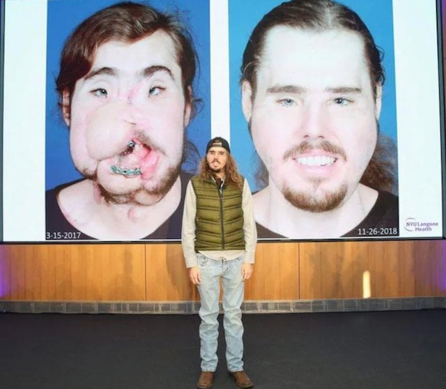 Cameron Underwood avant et après la greffe du visage