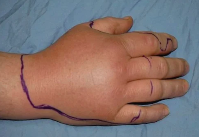 Une main gonfl&eacute;e