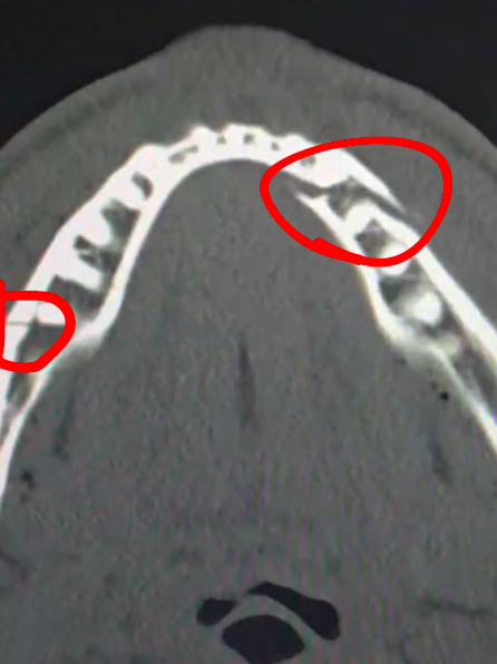 Post instagram montrant la double fracture de la m&acirc;choire du boxeur et vid&eacute;aste am&eacute;ricain Jake Paul