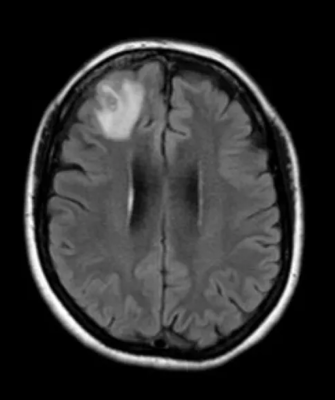 La l&eacute;sion dans le cerveau