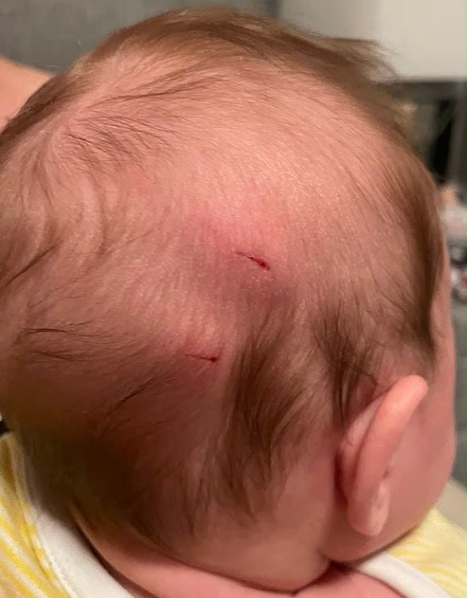 Les blessures du b&eacute;b&eacute;