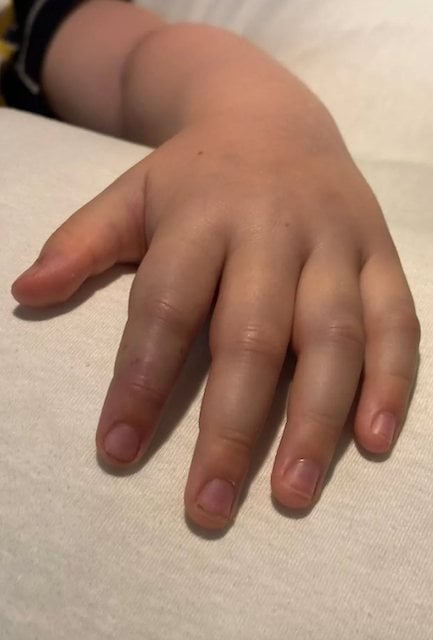 La main gonfl&eacute;e de Kenzie Macrae apr&egrave;s avoir &eacute;t&eacute; mordu