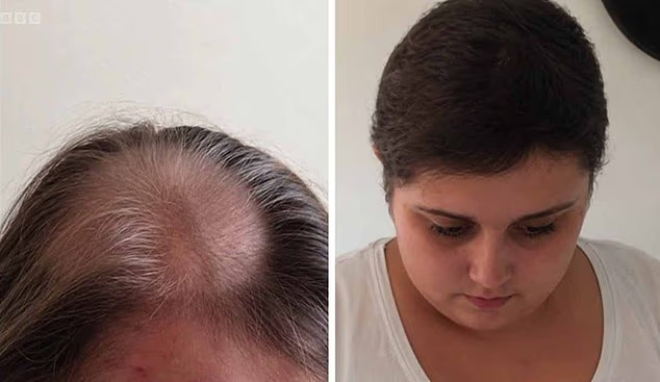 Becky Jones a perdu ses cheveux