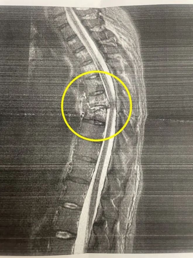 La fracture au dos