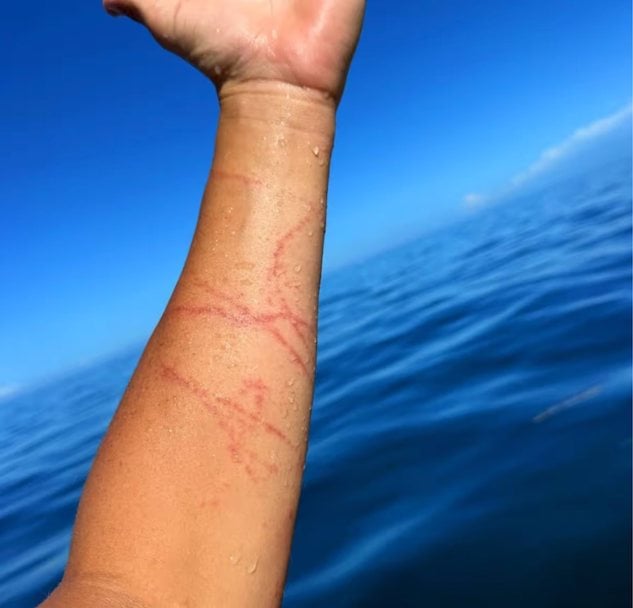 Le bras de Guy Rowles apr&egrave;s la piq&ucirc;re 