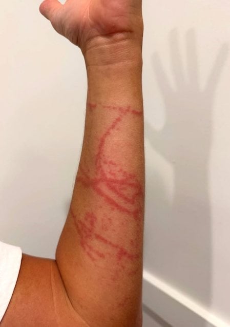 Le bras de Guy Rowles apr&egrave;s la piq&ucirc;re 