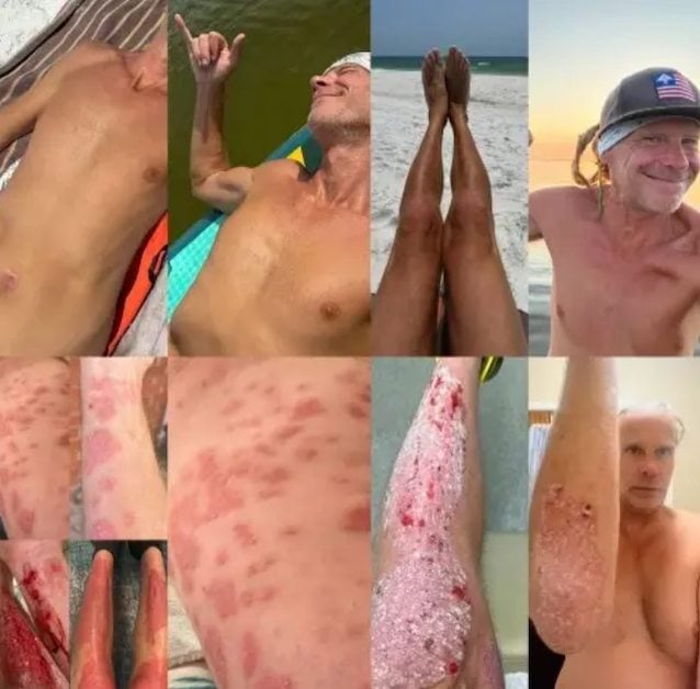 L'&eacute;volution du psoriasis de Stephen Lashbrook