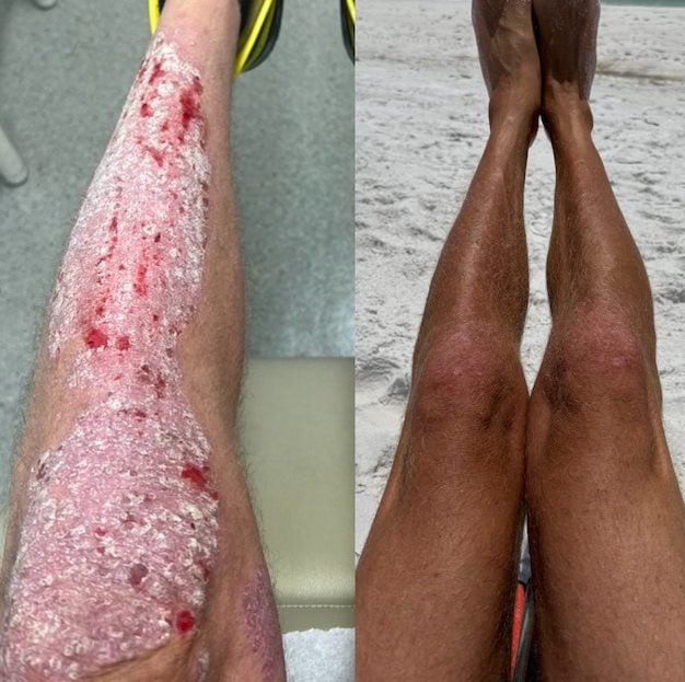 L'&eacute;volution du psoriasis de Stephen Lashbrook