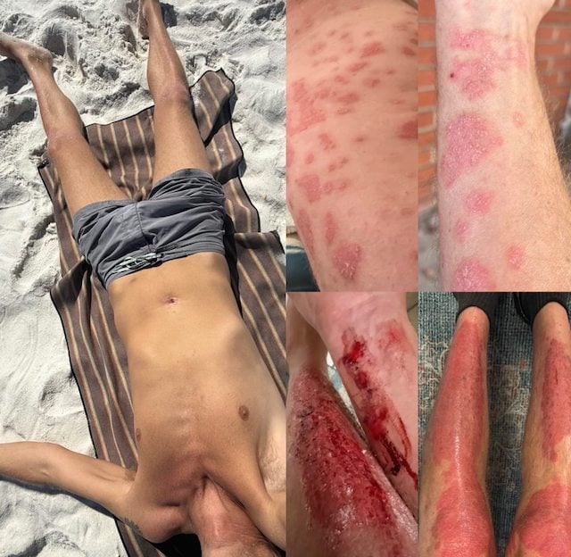 L'&eacute;volution du psoriasis de Stephen Lashbrook