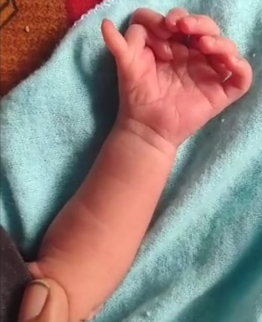 Une fillette de trois ans née avec 14 doigts vivra normalement