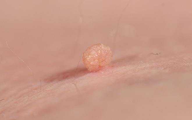 Peau présentant un acrochordon
