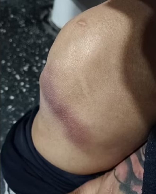 Genou blessé d'une spectatrice
