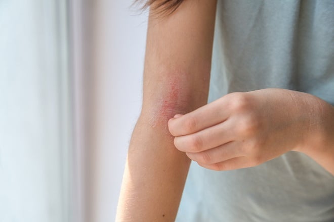 Infection cutanée au bras d'une fille